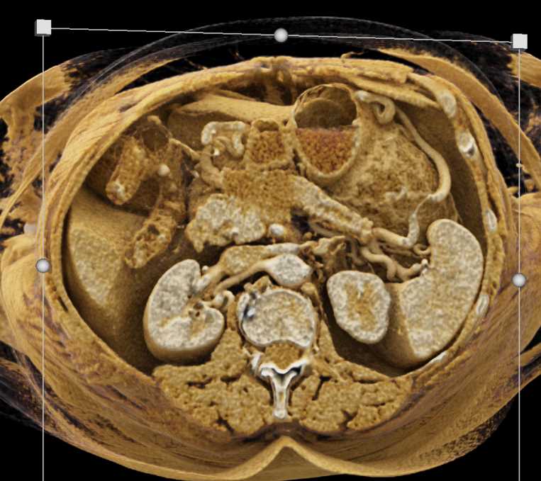 Pancreatic Adenocarcinoma Using Cinematic Rendering - CTisus CT Scan