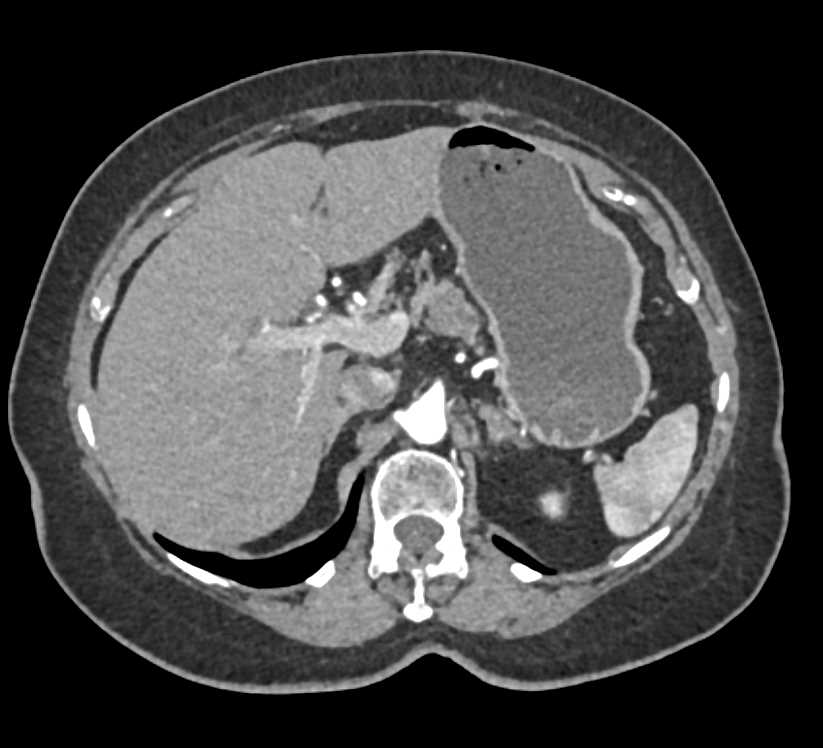 Carcinoma Body of the Pancreas with Dilated Pancreatic Duct - CTisus CT Scan