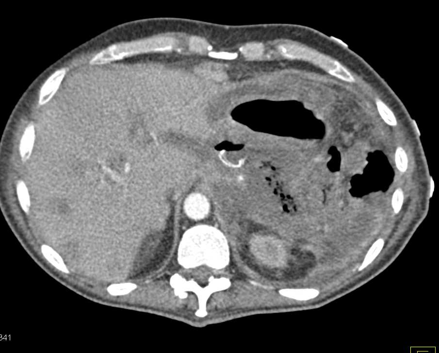 Pancreatic Cancer with Necrosis and Liver Metastases - CTisus CT Scan