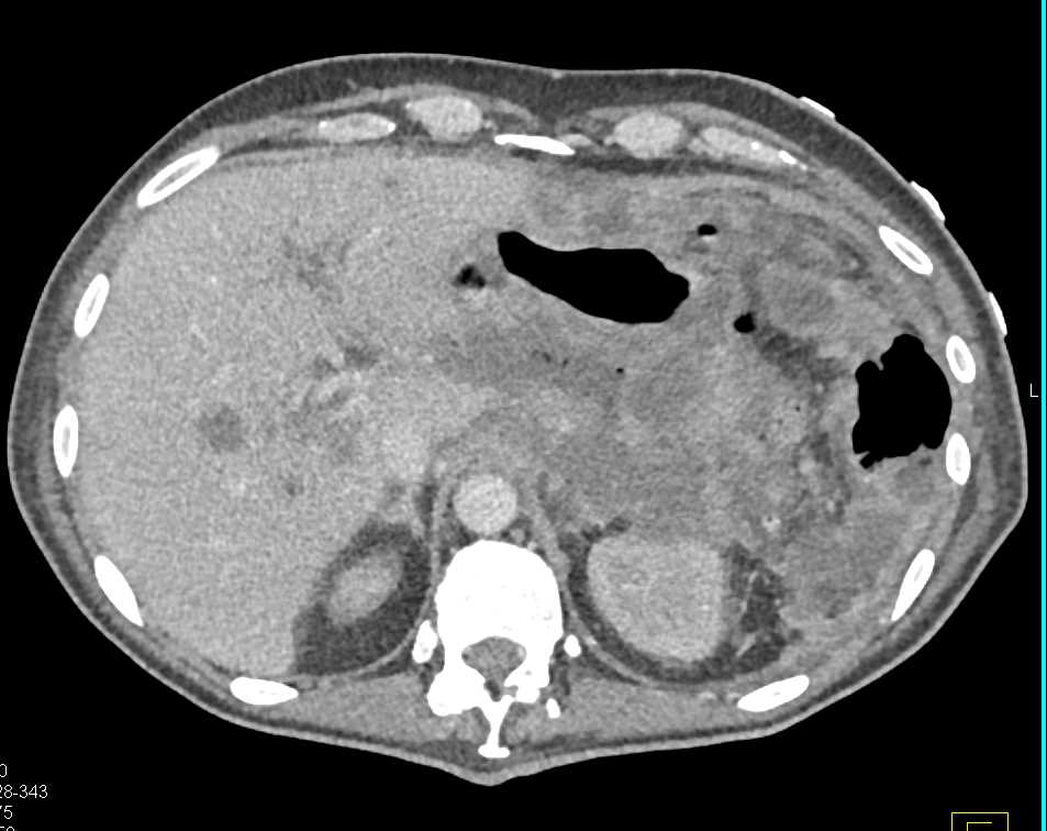 Pancreatic Cancer with Necrosis and Liver Metastases - CTisus CT Scan