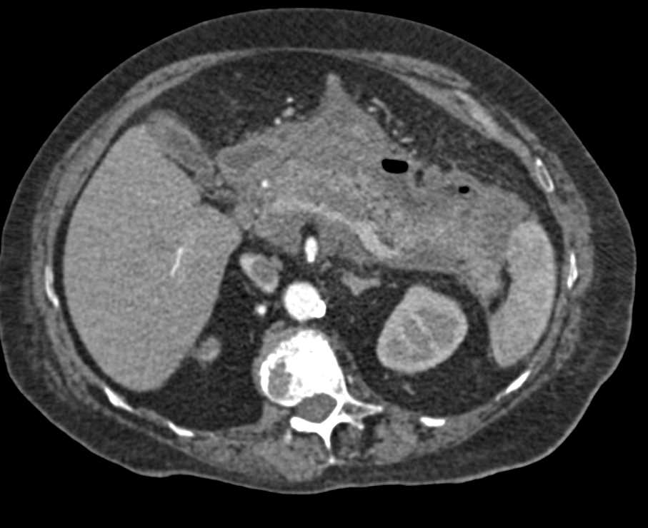 Acute Pancreatitis with Pancreatic Necrosis - CTisus CT Scan