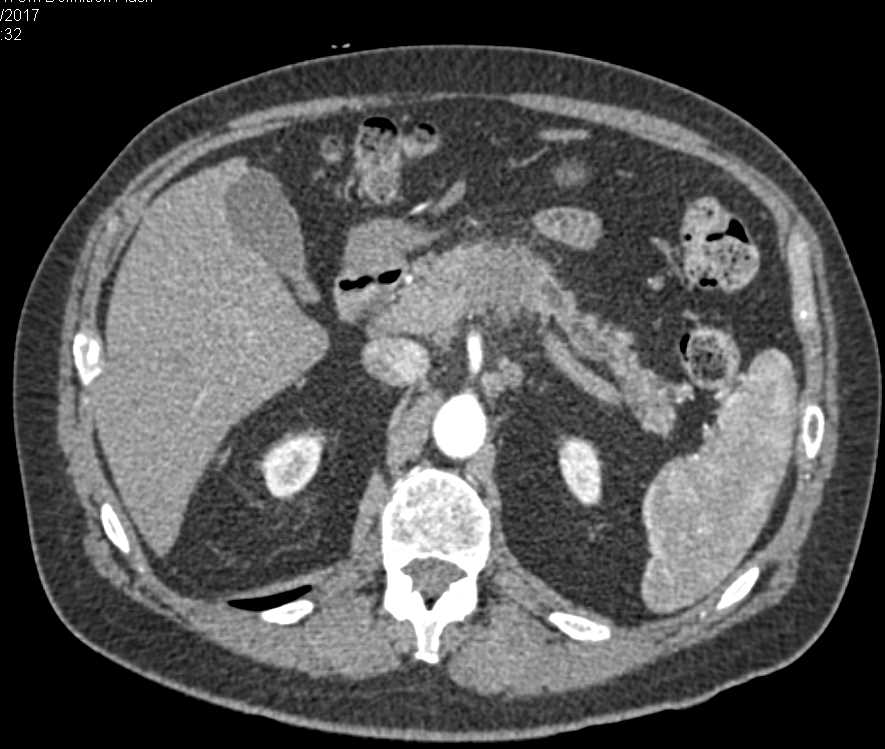 Carcinoma of the Body of the Pancreas - CTisus CT Scan