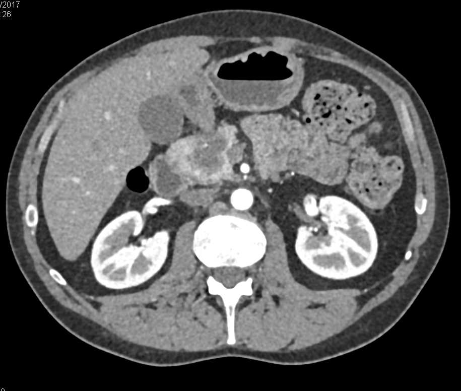 Adenocarcinoma Pancreas - CTisus CT Scan