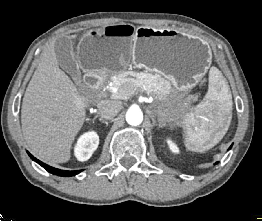 Carcinoma Tail of the Pancreas Obstructs the Duodenum at Ligament of Trietz - CTisus CT Scan