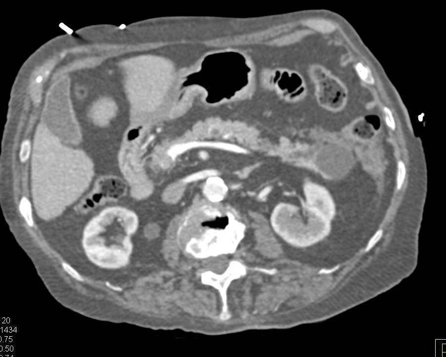 Intraductal Papillary Mucinous Neoplasm (IPMN) Tail of Pancreas - CTisus CT Scan