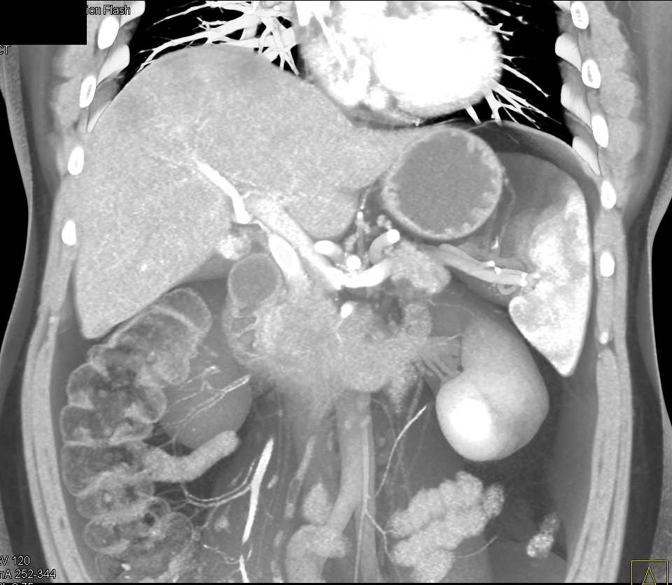 Pancreas Adenocarcinoma with Liver Metastases and Pulmonary Embolism - CTisus CT Scan
