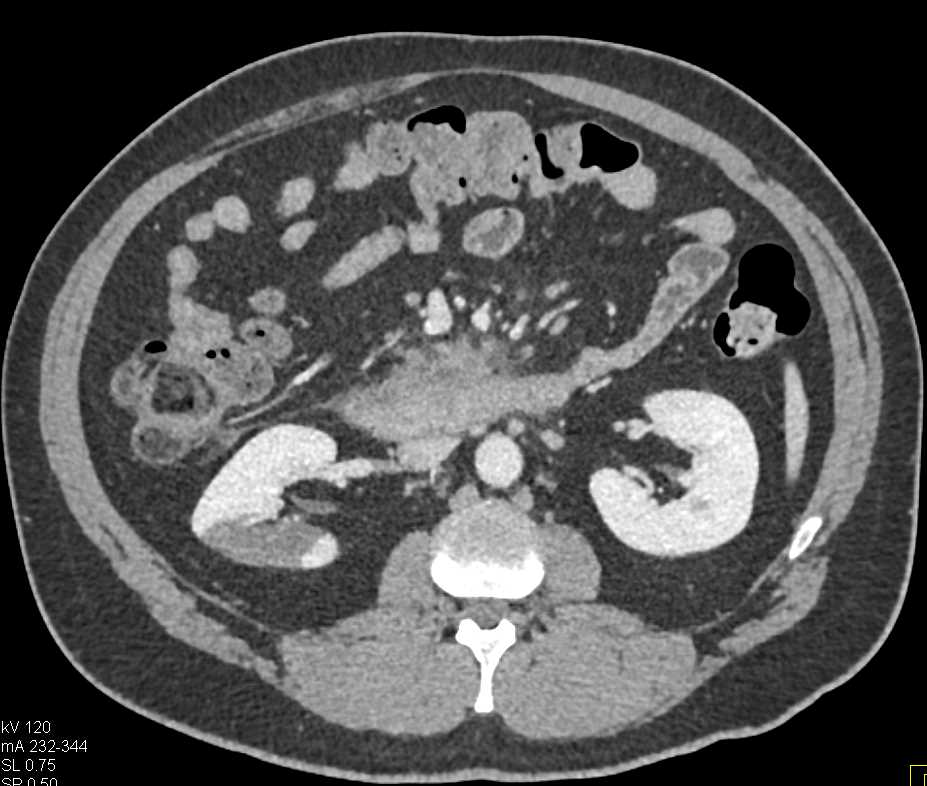 Pancreas Adenocarcinoma with Liver Metastases and Pulmonary Embolism - CTisus CT Scan