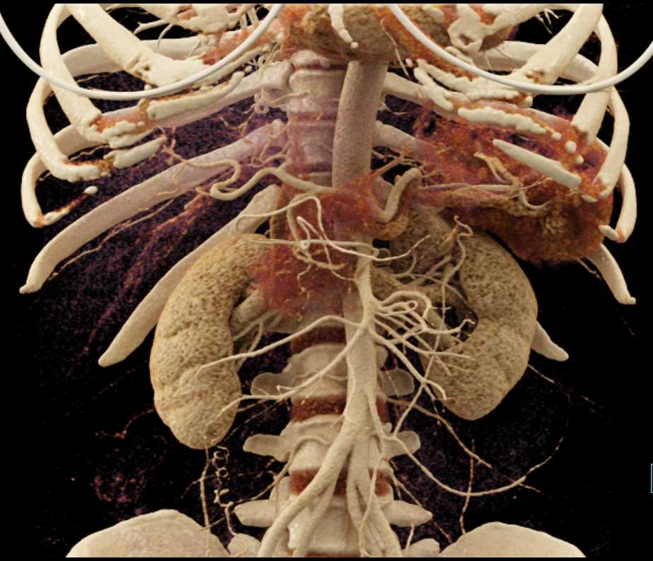 Pancreas Adenocarcinoma - CTisus CT Scan