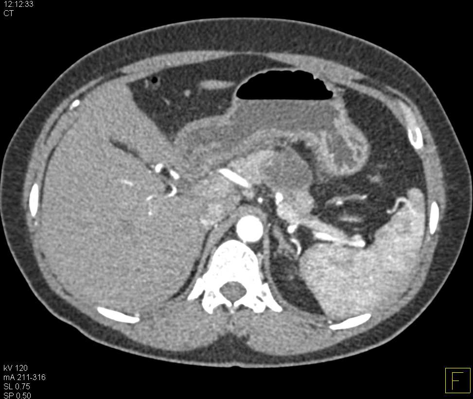 Mucinous Cystic Neoplasm (MCN) with Low Grade Dysplasia - CTisus CT Scan