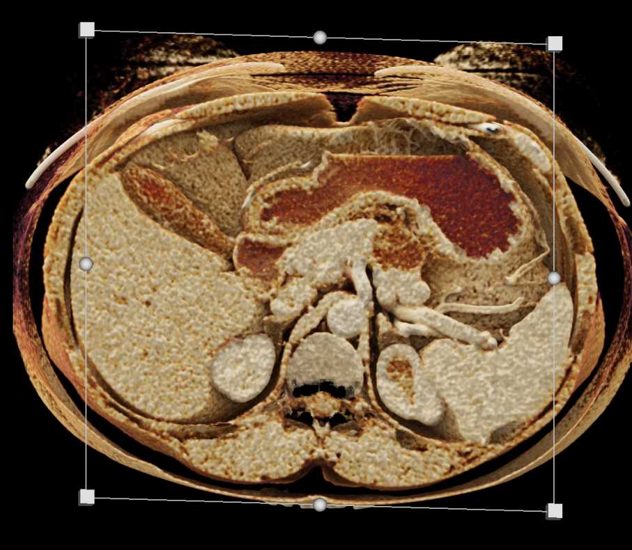 Mucinous Cystic Neoplasm (MCN) with Low Grade Dysplasia - CTisus CT Scan