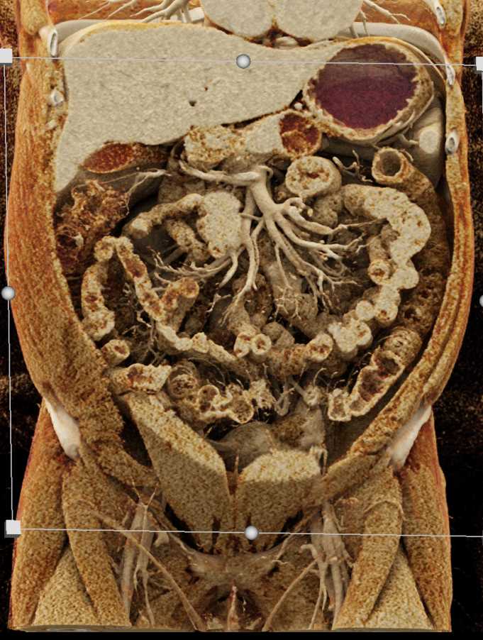 Mucinous Cystic Neoplasm (MCN) with Low Grade Dysplasia - CTisus CT Scan