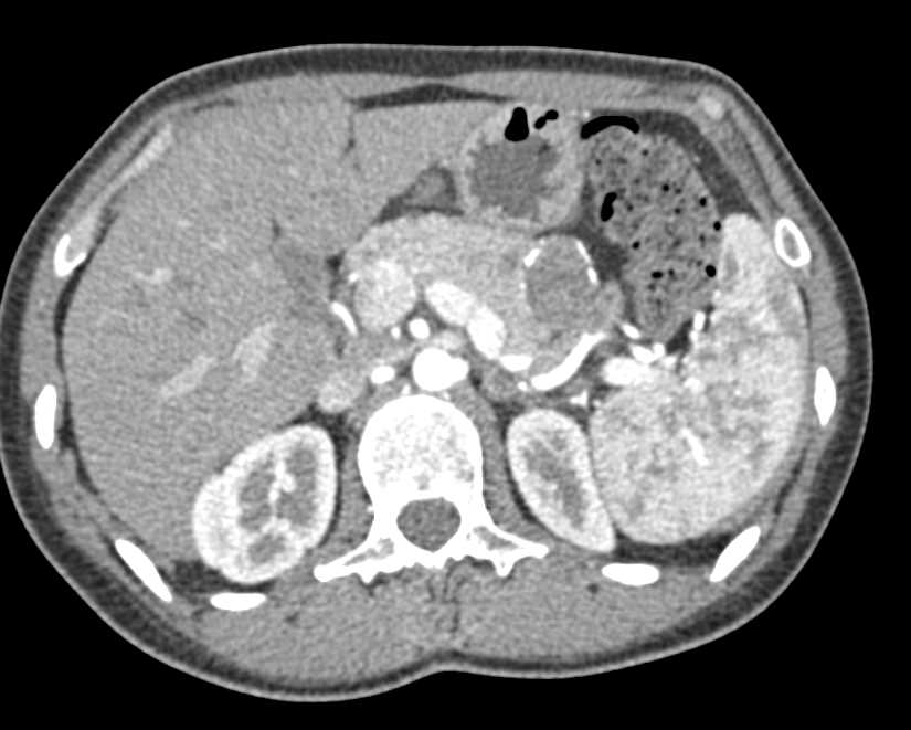 Solid and Papillary Epithelial Neoplasm (SPEN) Tumor - CTisus CT Scan