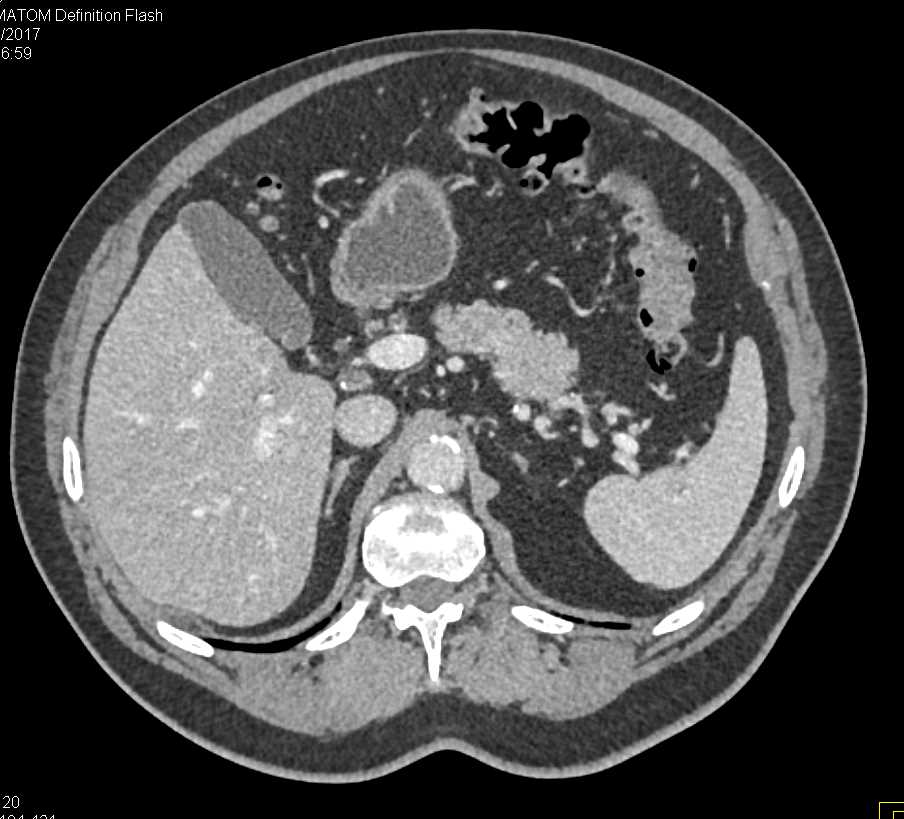 1cm Pancreatic Neuroendocrine Tumor (PNET) Body of Pancreas - CTisus CT Scan