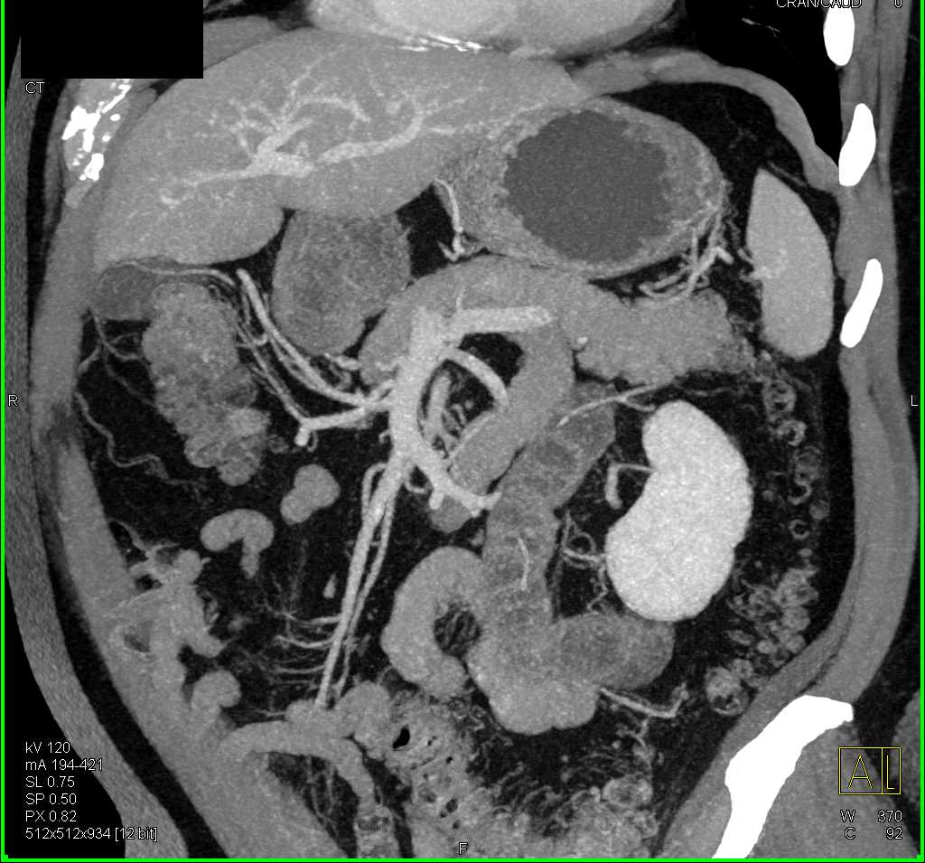 1cm Pancreatic Neuroendocrine Tumor (PNET) Body of Pancreas - CTisus CT Scan