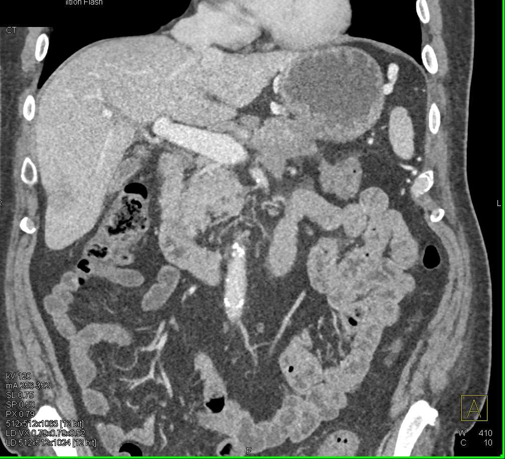 Carcinoma Body and Tail of Pancreas - CTisus CT Scan