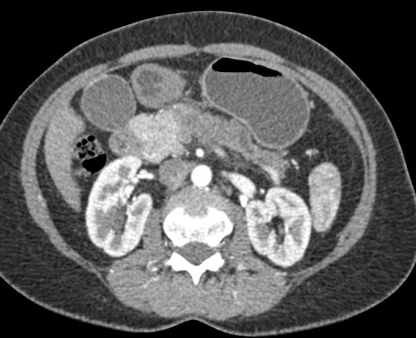 Carcinoma Body of Pancreas - CTisus CT Scan