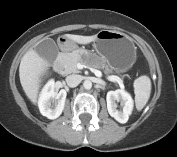 Carcinoma Body of Pancreas - CTisus CT Scan