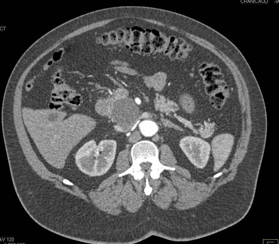 Intraductal Papillary Mucinous Neoplasm (IPMN) - CTisus CT Scan