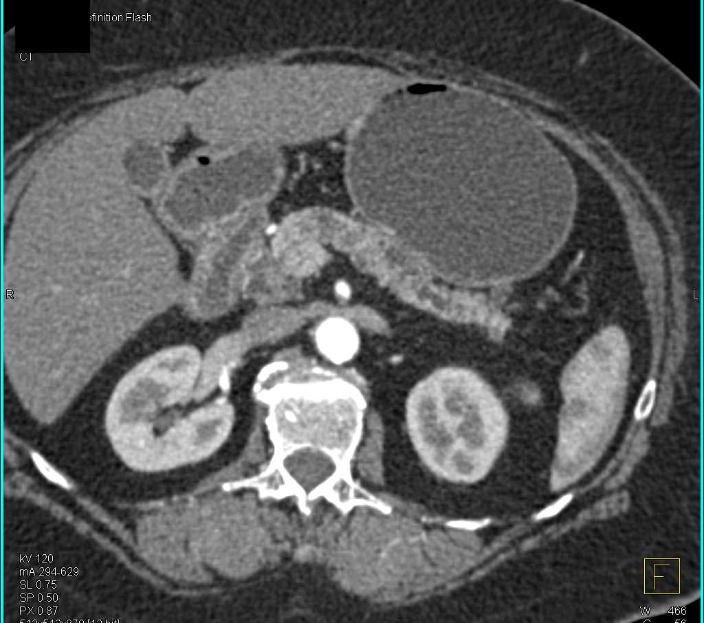 Mixed Type Intraductal Papillary Mucinous Neoplasm (IPMN) with High Grade Dysplasia - CTisus CT Scan