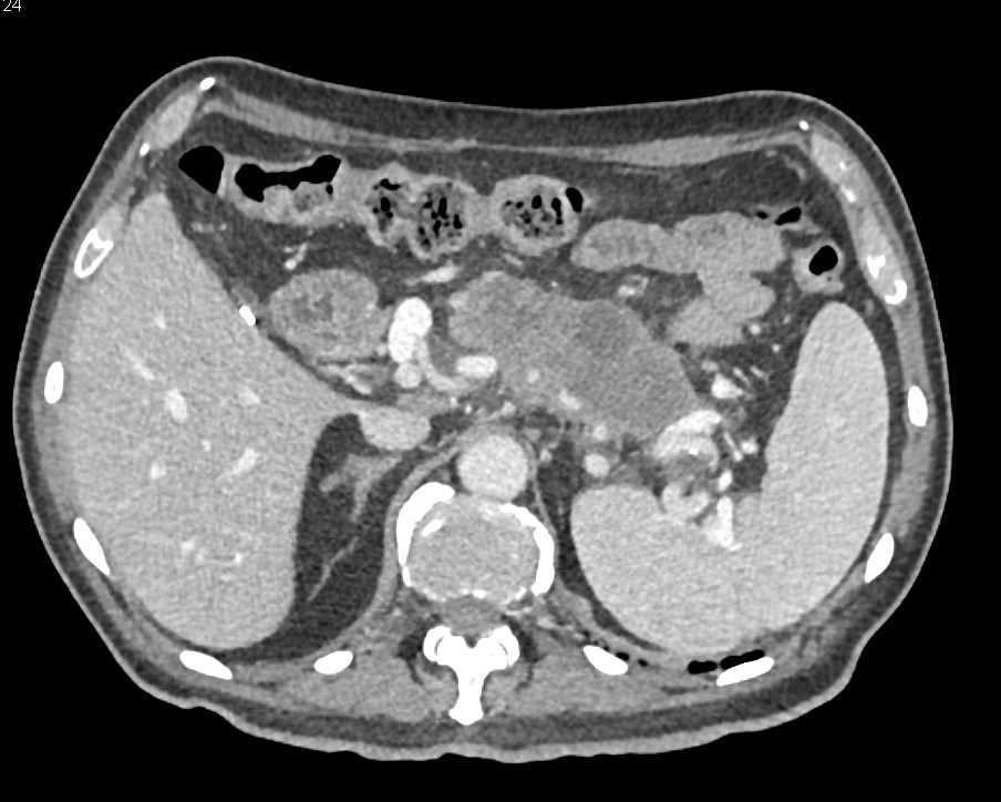 Adenocarcinoma Pancreas with Metastases to the Left Gluteal Muscles - CTisus CT Scan