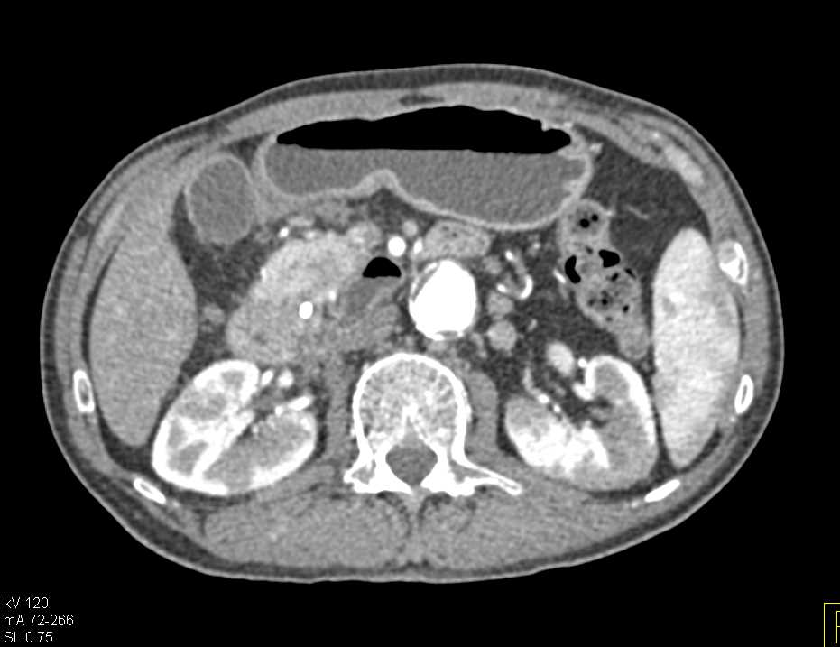 Autoimmune Pancreatitis and Renal Involvement - CTisus CT Scan