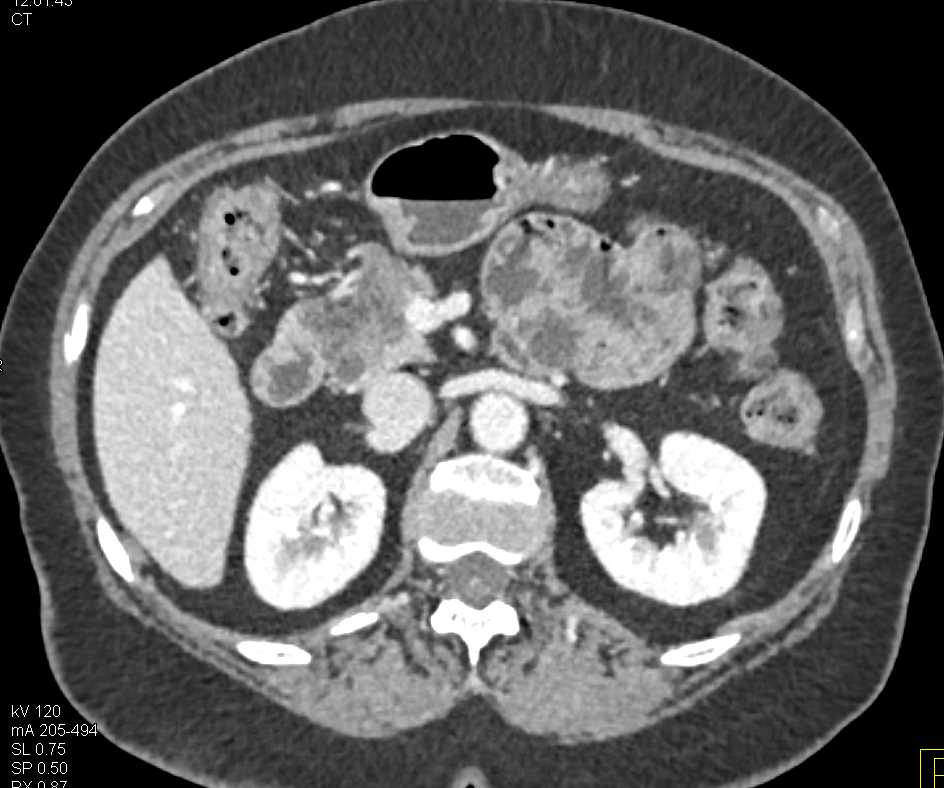 Autoimmune Pancreatitis - CTisus CT Scan