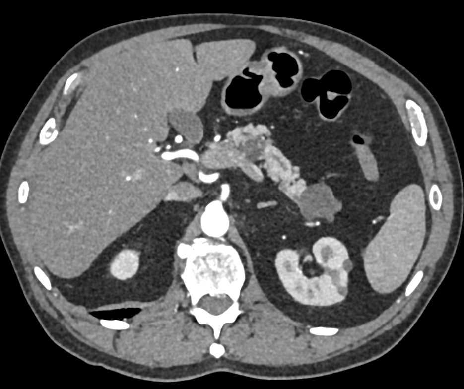 Multiple Intraductal Papillary Mucinous Neoplasms (IPMNs) - CTisus CT Scan