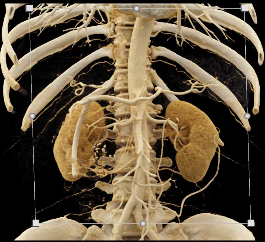 Serous Cystadenoma Pancreas - CTisus CT Scan