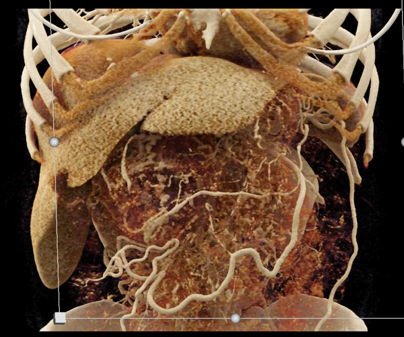 Serous Cystadenoma Pancreas - CTisus CT Scan