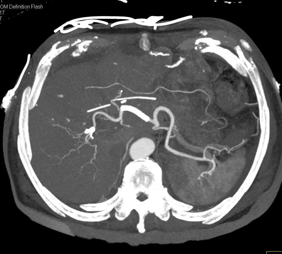 Post-Op Whipples Procedure - CTisus CT Scan