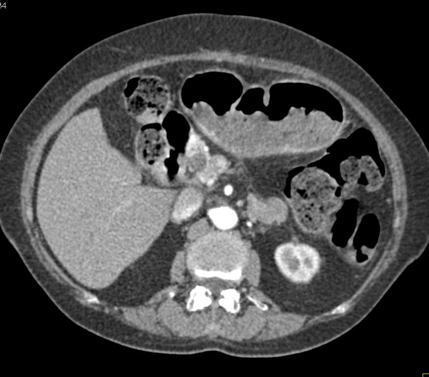 High Grade Dysplasia in Intraductal Papillary Mucinous Neoplasm (IPMN) - CTisus CT Scan