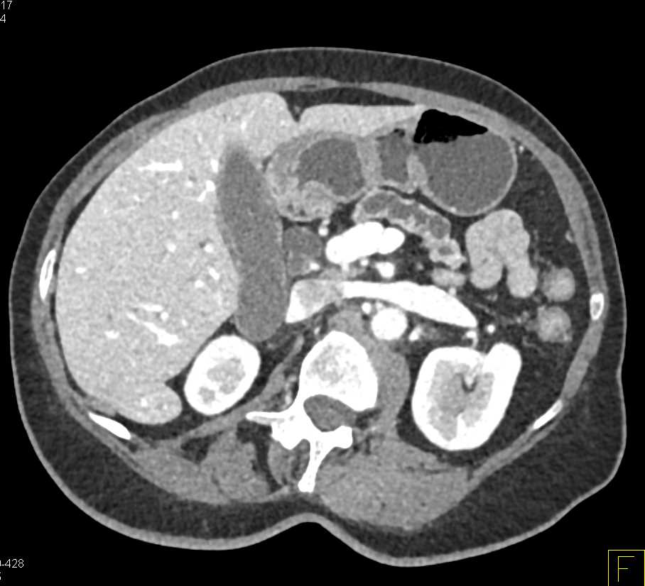 Pancreas Adenocarcinoma with Dilated Pancreatic Duct - CTisus CT Scan