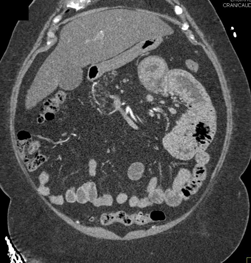 Fatty Infiltration Pancreas - CTisus CT Scan