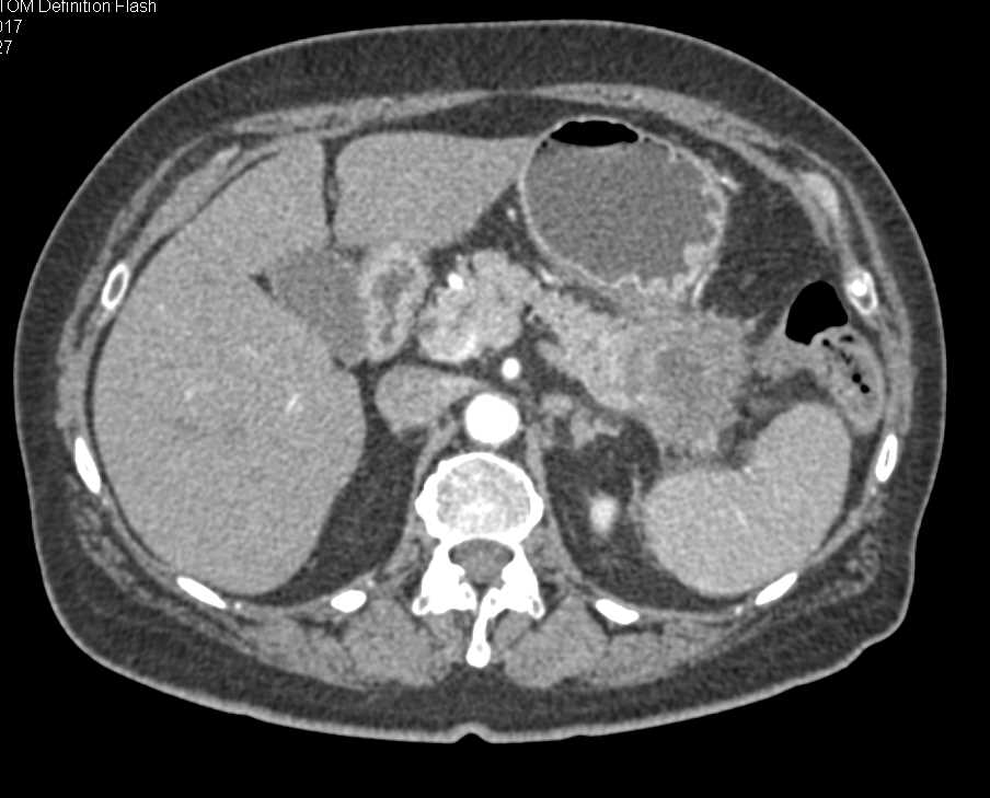 Carcinoma Tail of Pancreas - CTisus CT Scan