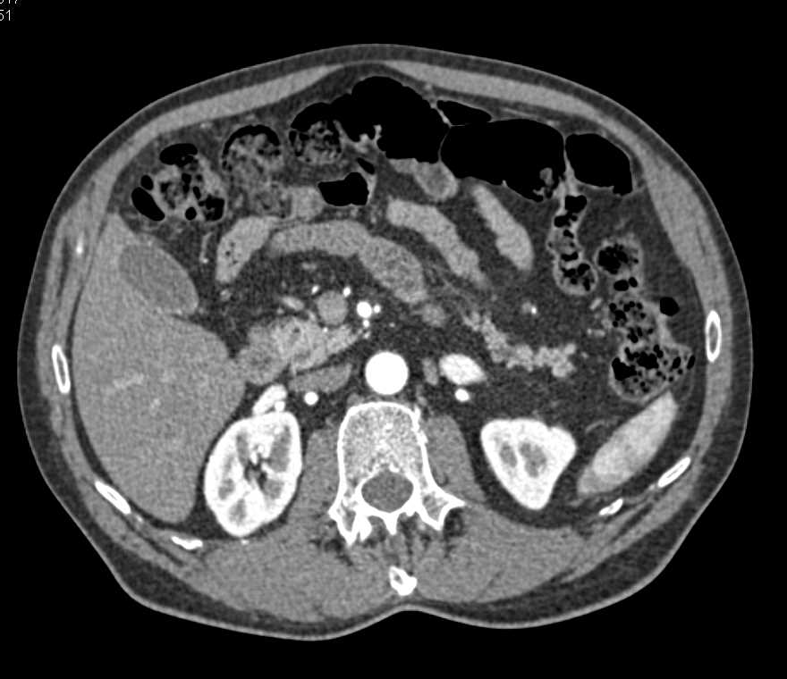 Carcinoma Tail of the Pancreas - CTisus CT Scan