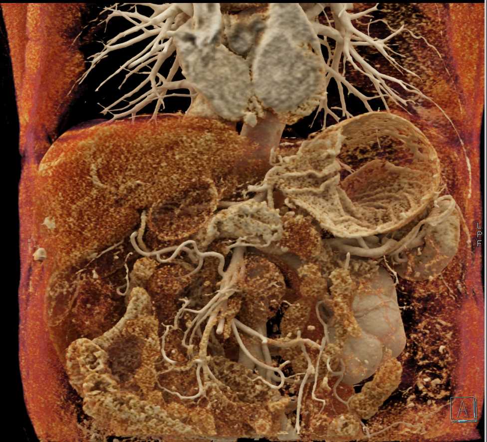 Carcinoma Tail of the Pancreas - CTisus CT Scan