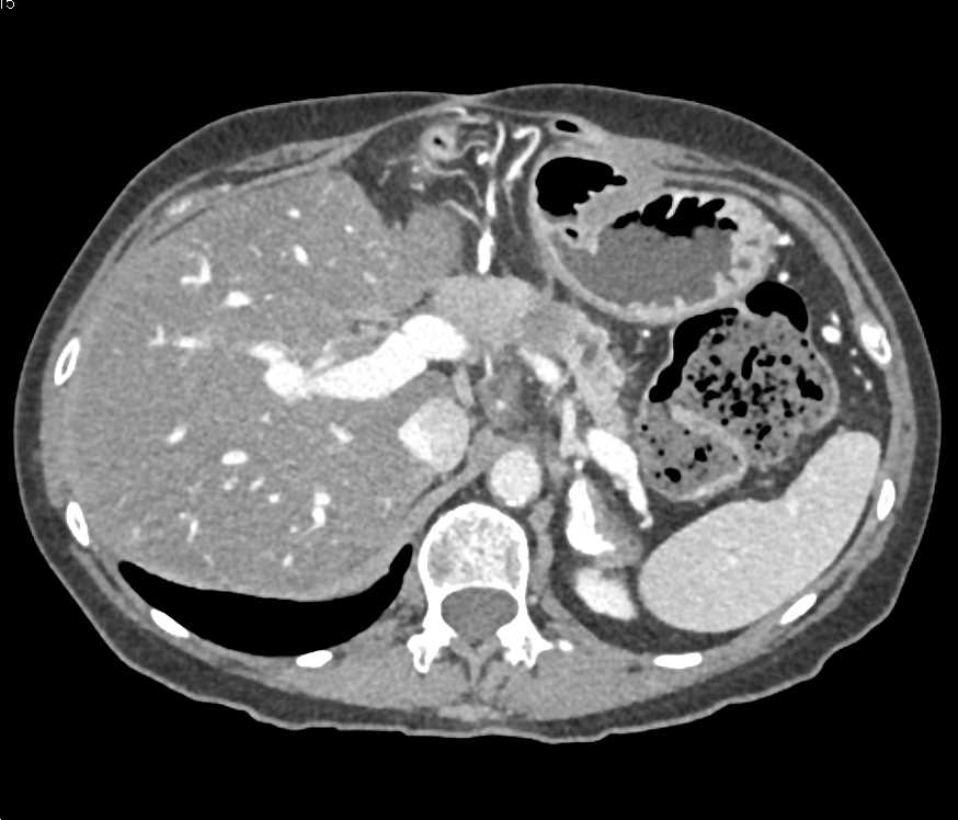 Adenocarcinoma Body of Pancreas - CTisus CT Scan