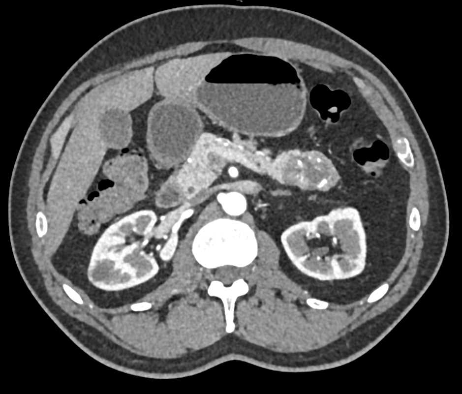 Cystic Pancreatic Neuroendocrine Tumor (PNET) Tail of the Pancreas - CTisus CT Scan