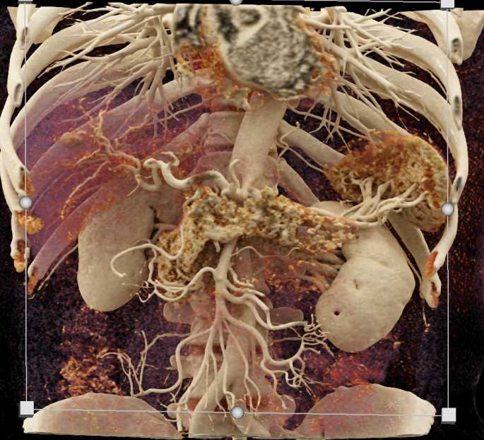 Cystic Pancreatic Neuroendocrine Tumor (PNET) Tail of the Pancreas with Cinematic Rendering - CTisus CT Scan