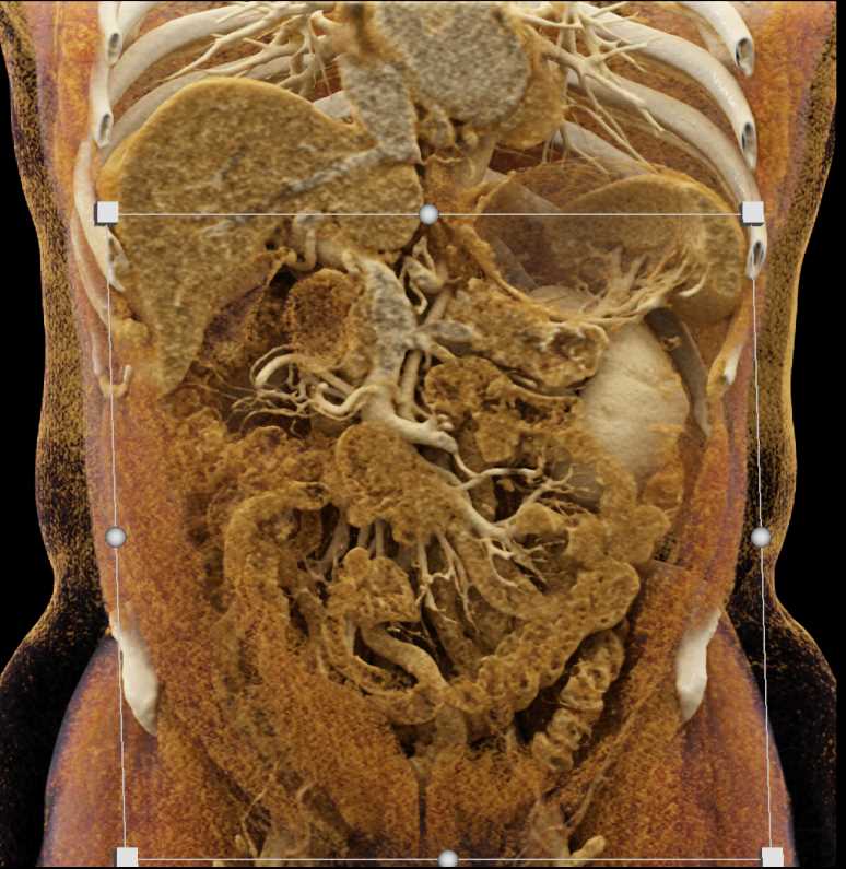 Cystic Pancreatic Neuroendocrine Tumor (PNET) Tail of the Pancreas with Cinematic Rendering - CTisus CT Scan