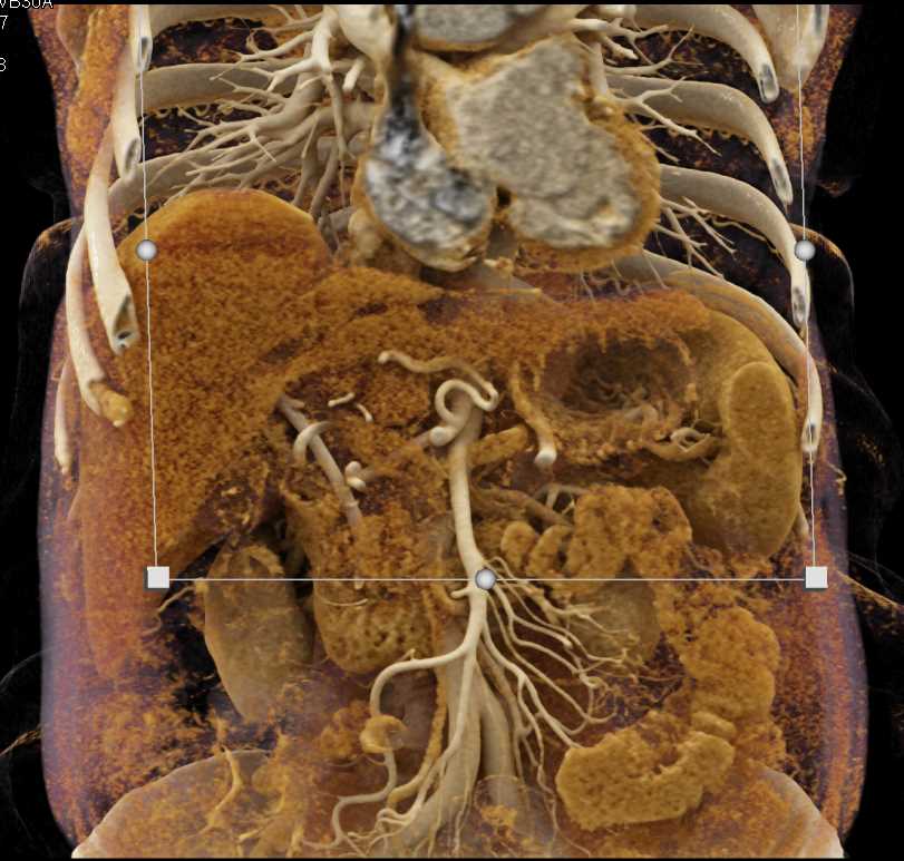 Pancreatic Cancer with Common Bile Duct (CBD) Stent with Cinematic Rendering - CTisus CT Scan