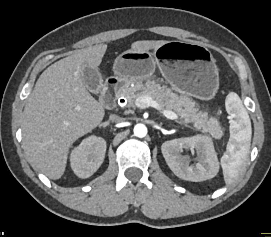 Stent in the Common Bile Duct with AIP-Autoimmune Pancreatitis - CTisus CT Scan