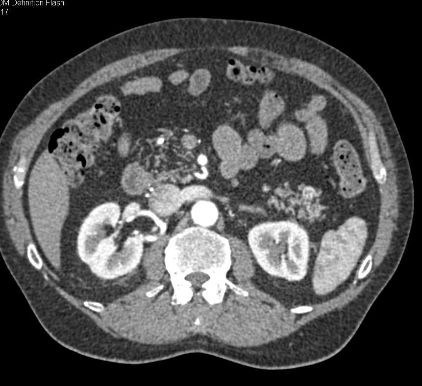 Pancreatic Neuroendocrine Tumor (PNET) in the Tail of the Pancreas - CTisus CT Scan