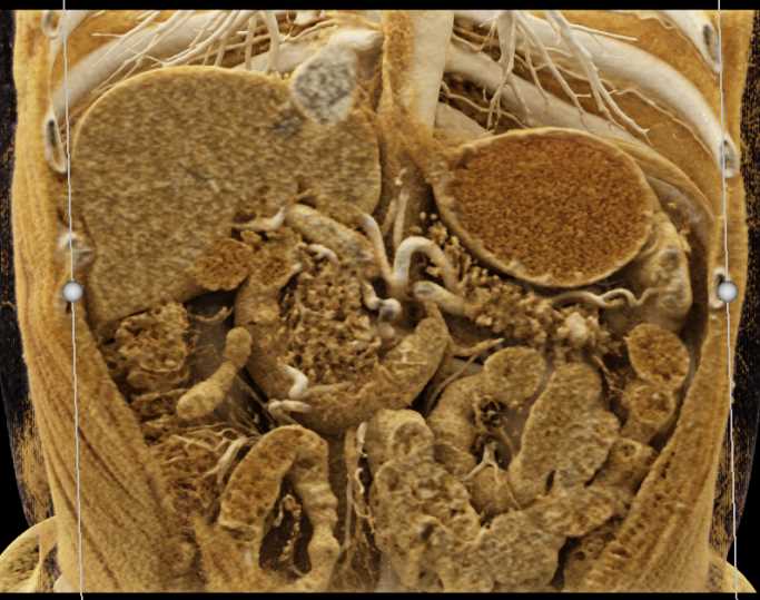 Pancreatic Neuroendocrine Tumor (PNET) in the Tail of the Pancreas - CTisus CT Scan