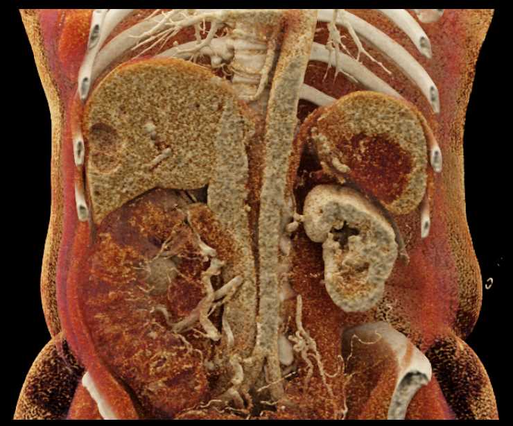 Carcinoma Tail of Pancreas Involves the Spleen - CTisus CT Scan