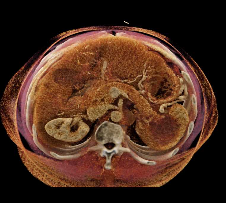 Carcinoma Tail of Pancreas Involves the Spleen - CTisus CT Scan