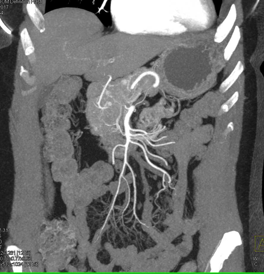 Metastatic Renal Cell Carcinoma to Head of Pancreas - CTisus CT Scan