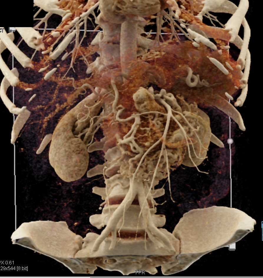 Pancreatic Cancer with Vascular Invasion - CTisus CT Scan