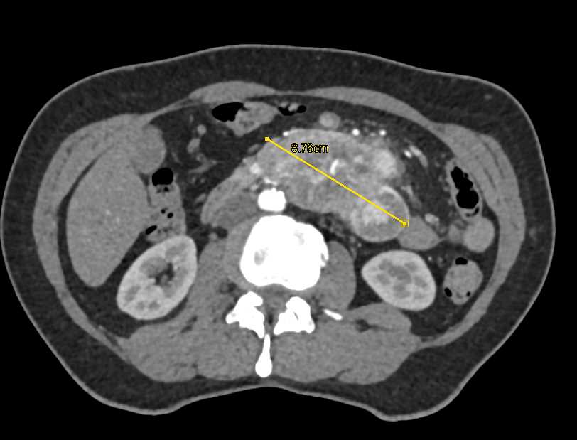 Pancreatic Cancer with Vascular Invasion - CTisus CT Scan