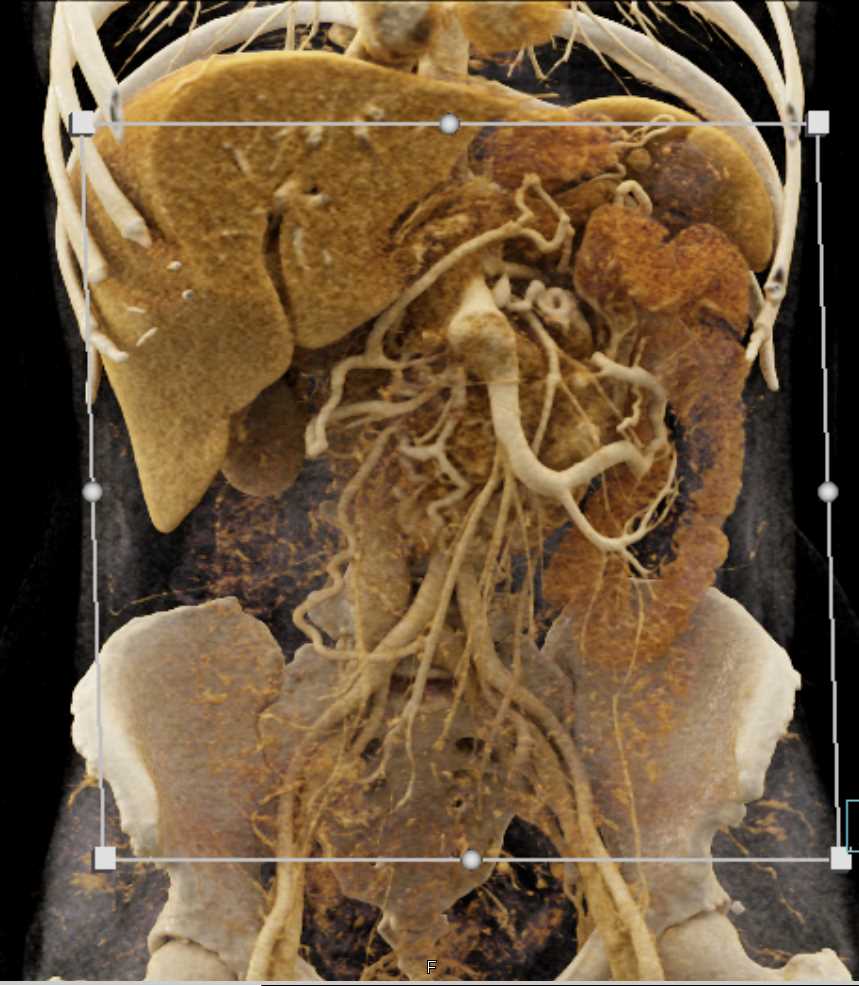 Pancreatic Cancer with Vascular Invasion - CTisus CT Scan